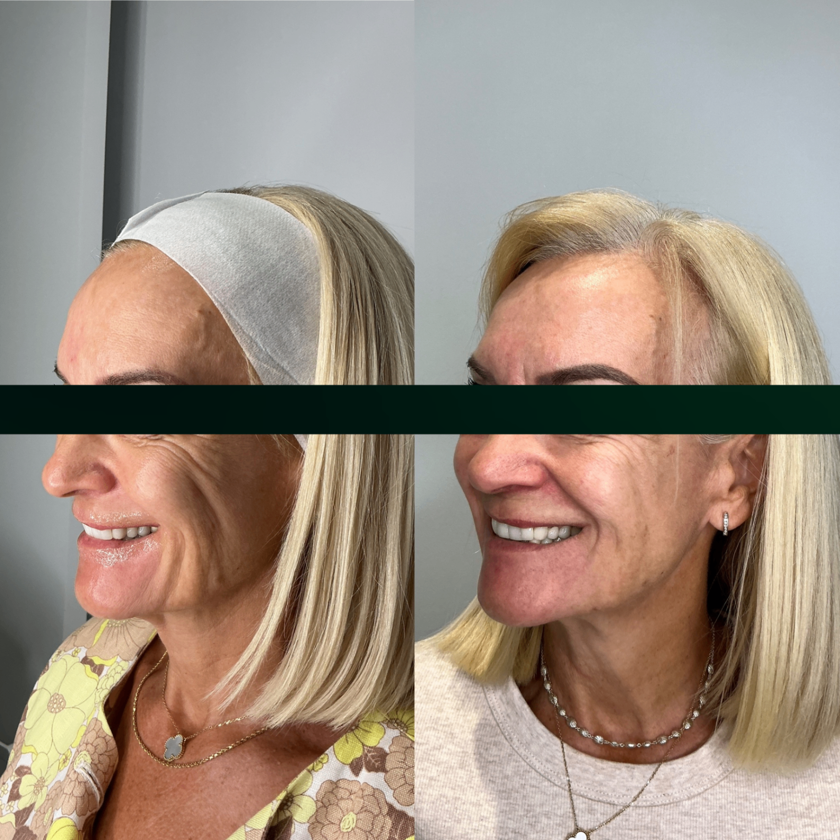 Lower Face Firmness before and after result