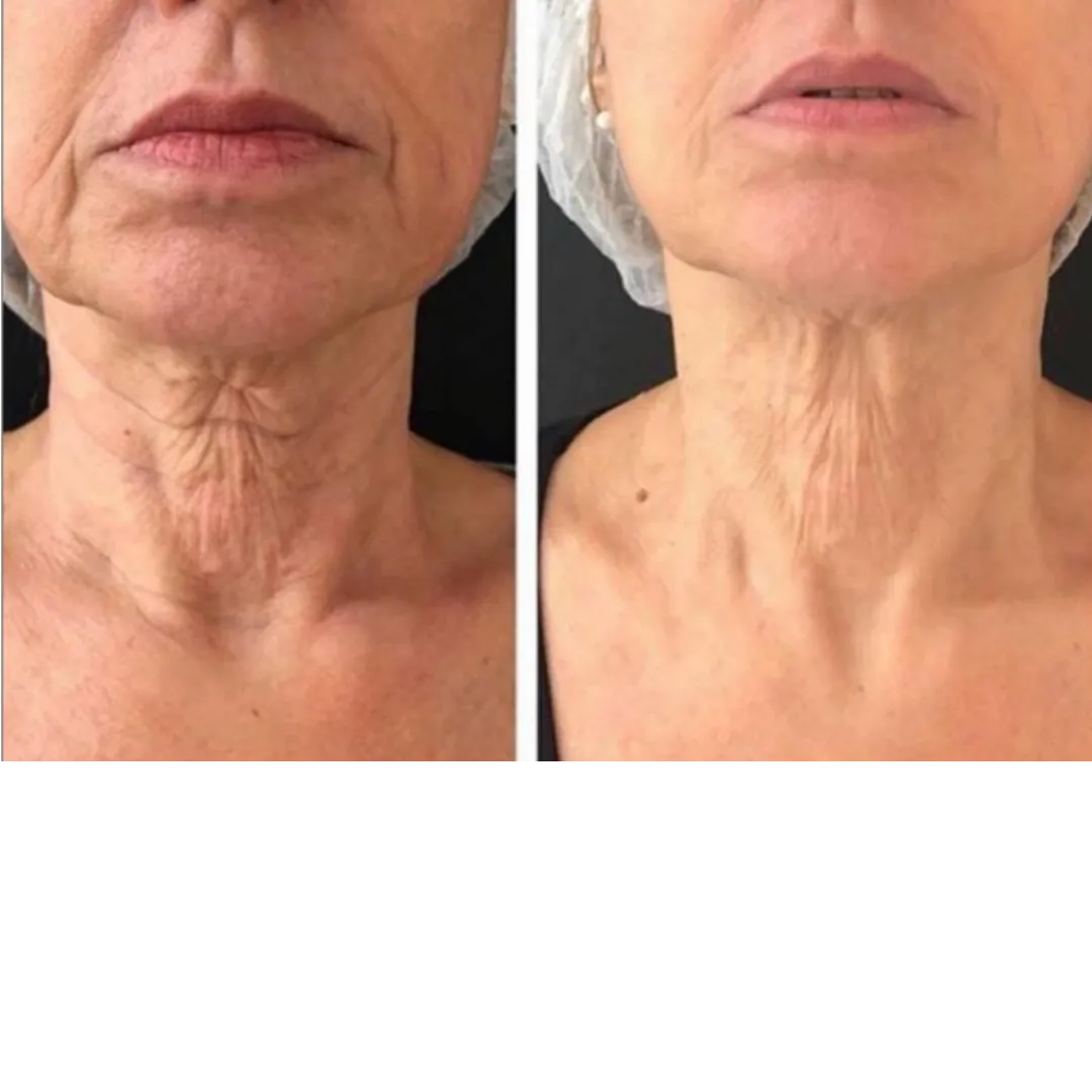 Neck Rejuvenation before and after result