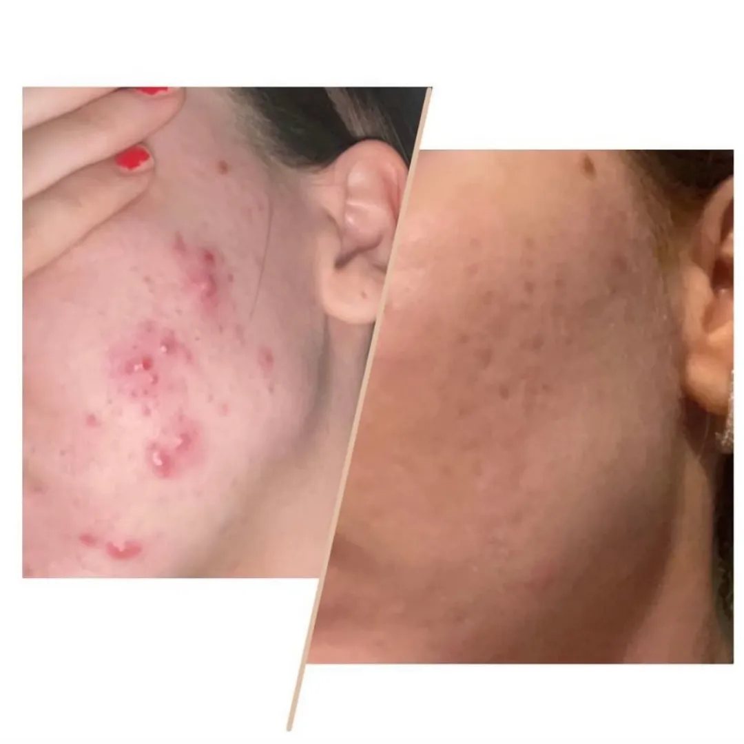 Breakouts & Texture before and after result
