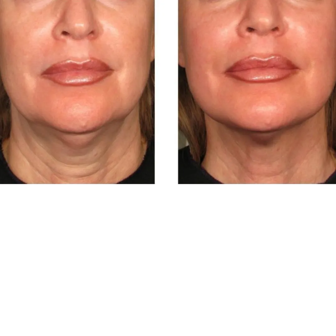 Jawline & Neck Definition before and after result